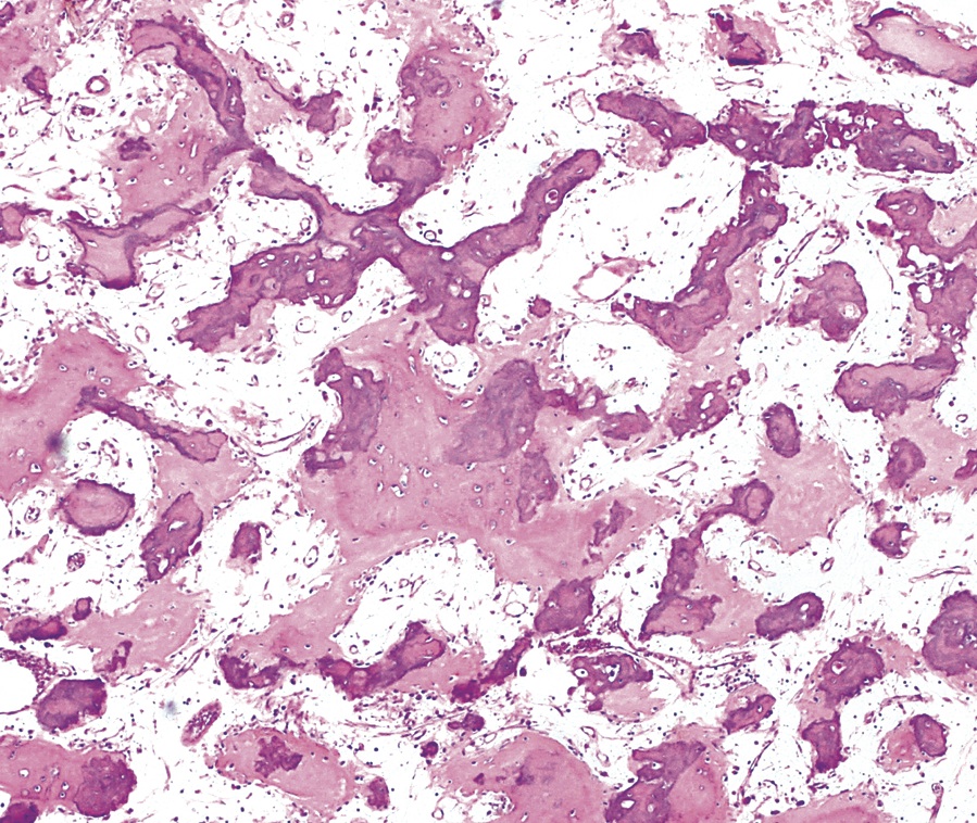 Pathology Outlines - Osteoblastoma-like